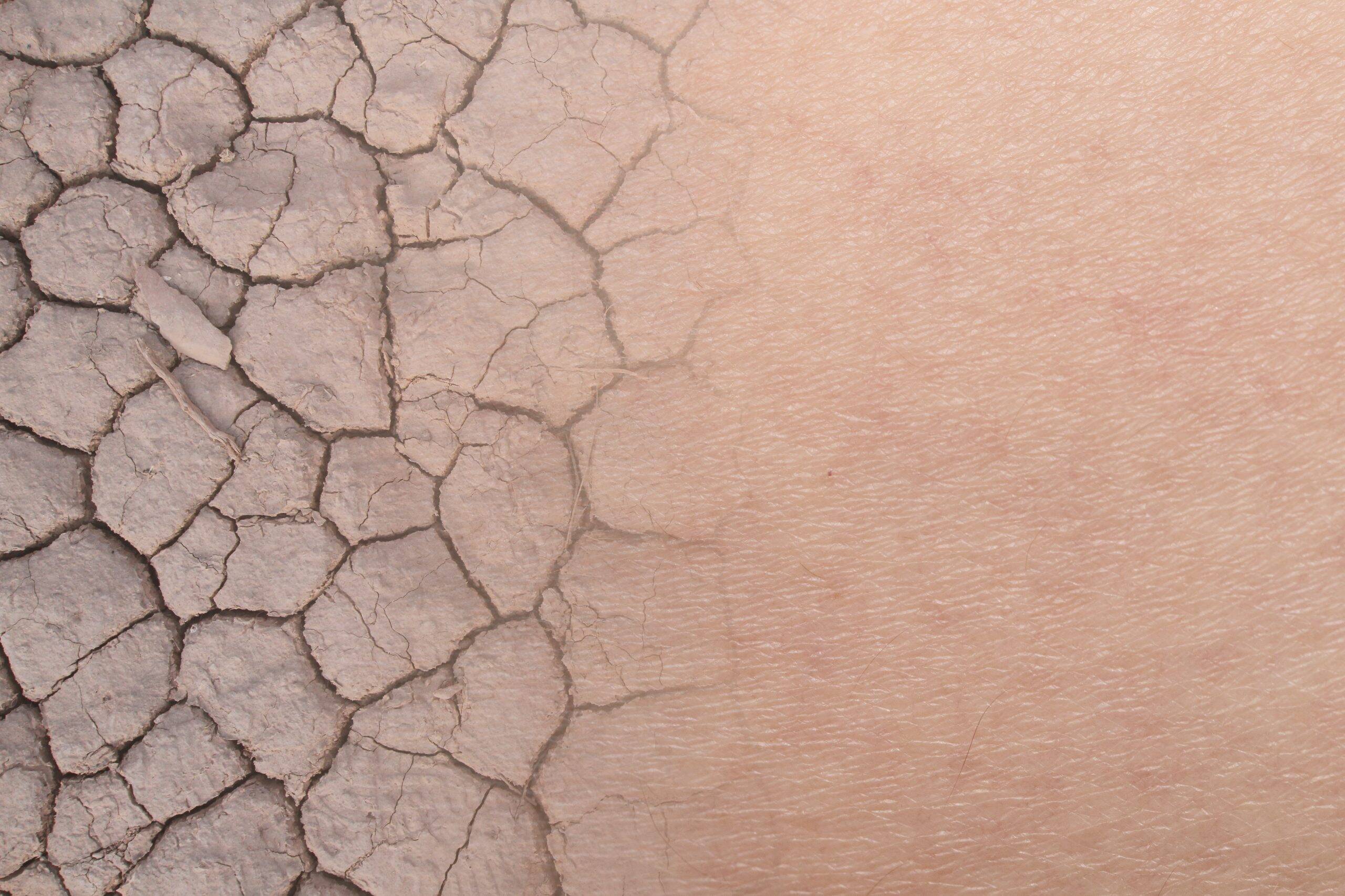 Does Hard Water cause skin problems? A look into the science.