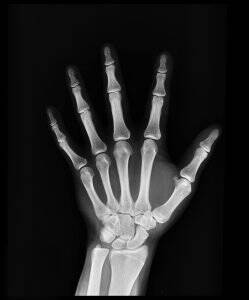 x-ray of a hand showing healthy bones from drinking calcium in hard water